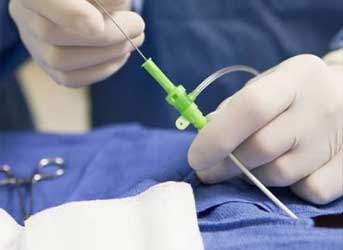 Cirurgia de varizes a laser em Curitiba - entenda qual laser é para vasinhos e qual é para safena.