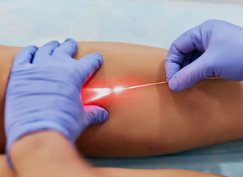 Cirurgia de varizes com Endolaser para safena em Curitiba