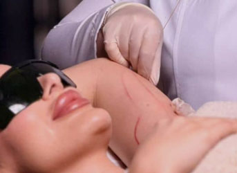 Tratamento com Endolift para braços flacidos