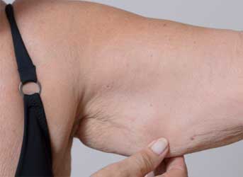 Tratamento com Endolift para braços flacidos