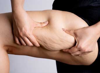 Endolift para coxas e joelhos em Curitiba