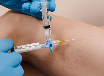 Escleroterapia com espuma em Curitiba - varizes médias