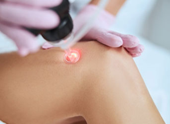 Laser transdérmico para vasinhos, sem cirurgia