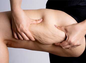 Tratamento de Lipedema em Curitiva com médico angiologista e cirurgião vascular