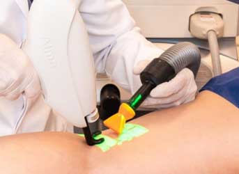Tratamento de varizes e vasinhos a laser